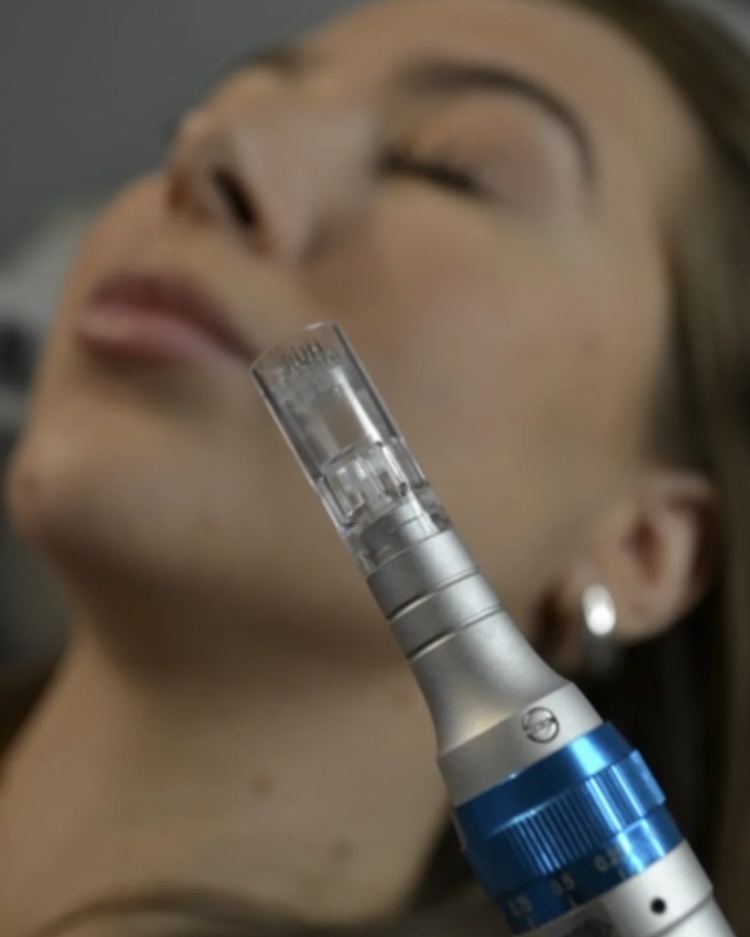 Microneedling